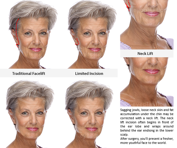 traditional facelift face lift jowl surgery loose neck